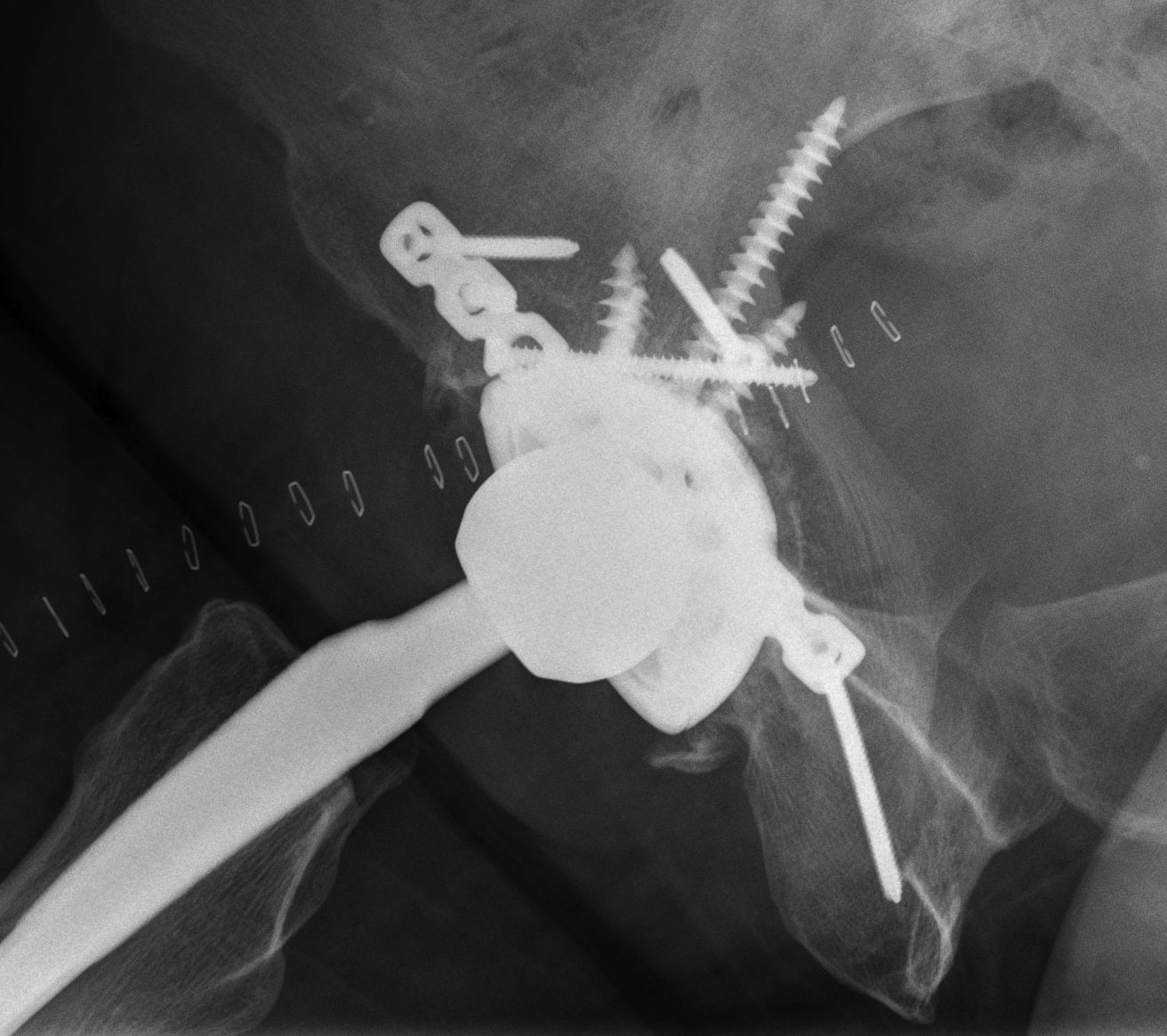 THR Fractured Acetabulum 3